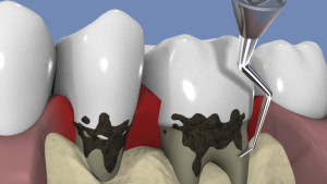 Le traitement chirurgical de la parodontite